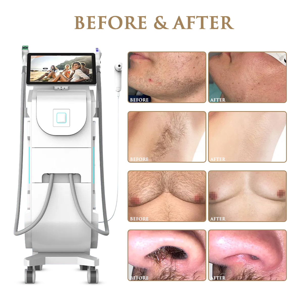 Skin Monarch Quantum Pro Diode & Picosecond Laser